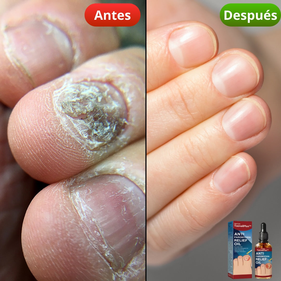 NATURNAIL CARE™2X1 : Cura y previene Hongos e infecciones.