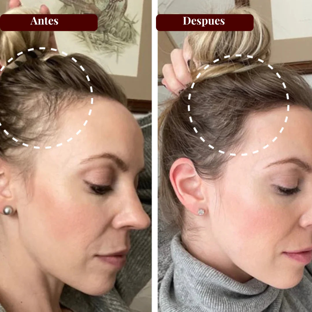 FULLHAIR™ SM 💇♂️: Estimula el crecimiento capilar desde la raíz con luz roja y azul.