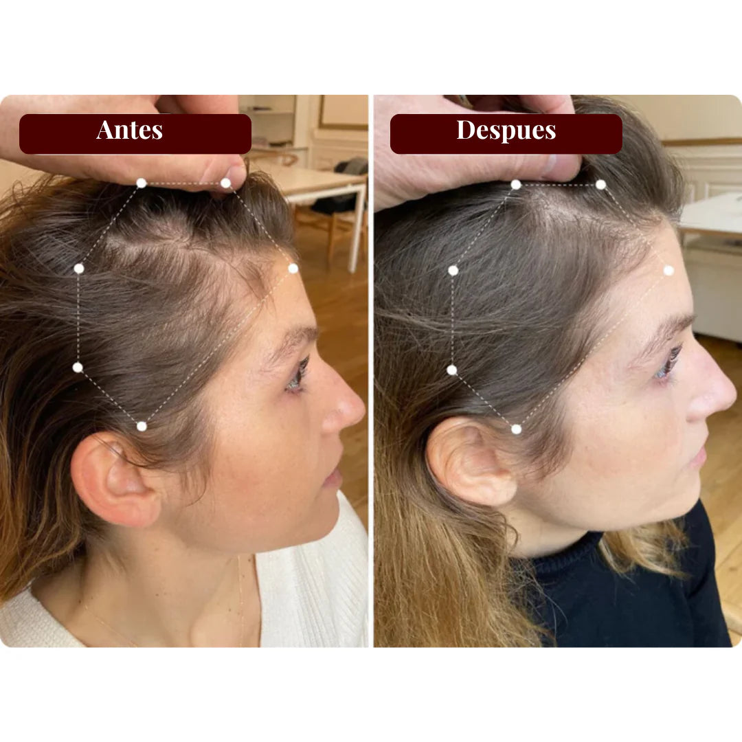 FULLHAIR™ SM 💇♂️: Estimula el crecimiento capilar desde la raíz con luz roja y azul.